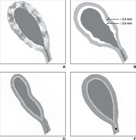 normal gallbladder wall thickness measurement|gallbladder wall thickening on ultrasound.